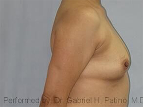  Before and After Cosmetic Surgery in Oakland, CA 