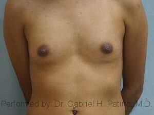  Before and After Cosmetic Surgery in Oakland, CA 