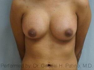  Before and After Cosmetic Surgery in Oakland, CA 