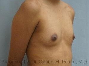  Before and After Cosmetic Surgery in Oakland, CA 