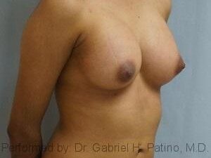  Before and After Cosmetic Surgery in Oakland, CA 