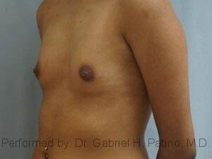  Before and After Cosmetic Surgery in Oakland, CA 