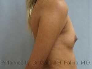  Before and After Cosmetic Surgery in Oakland, CA 