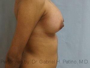  Before and After Cosmetic Surgery in Oakland, CA 