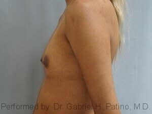  Before and After Cosmetic Surgery in Oakland, CA 