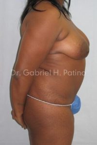  Before and After Cosmetic Surgery in Oakland, CA 