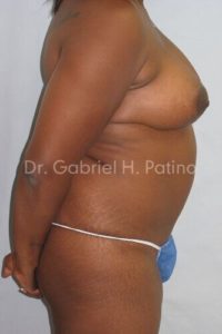  Before and After Cosmetic Surgery in Oakland, CA 