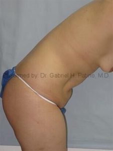  Before and After Cosmetic Surgery in Oakland, CA 