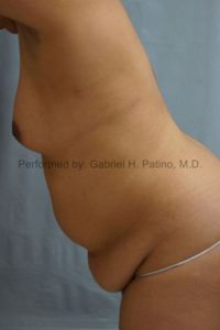  Before and After Cosmetic Surgery in Oakland, CA 