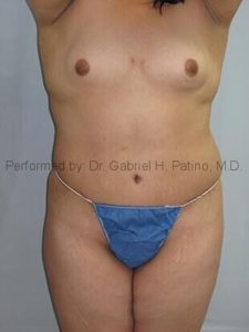  Before and After Cosmetic Surgery in Oakland, CA 