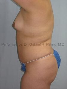  Before and After Cosmetic Surgery in Oakland, CA 