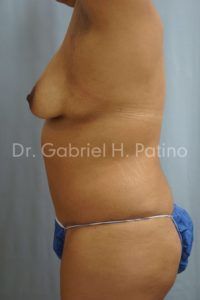  Before and After Cosmetic Surgery in Oakland, CA 