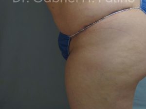  Before and After Cosmetic Surgery in Oakland, CA 