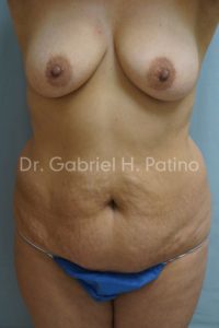  Before and After Cosmetic Surgery in Oakland, CA 