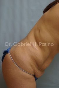  Before and After Cosmetic Surgery in Oakland, CA 