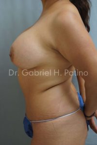  Before and After Cosmetic Surgery in Oakland, CA 