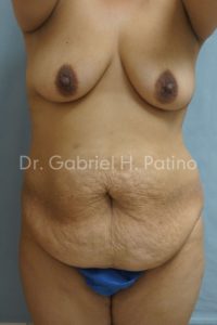  Before and After Cosmetic Surgery in Oakland, CA 