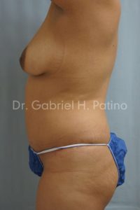  Before and After Cosmetic Surgery in Oakland, CA 