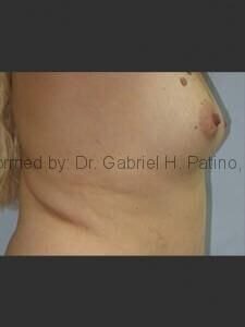  Before and After Cosmetic Surgery in Oakland, CA 