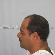  Before and After Cosmetic Surgery in Oakland, CA 