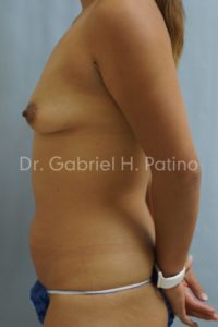  Before and After Cosmetic Surgery in Oakland, CA 