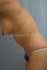  Before and After Cosmetic Surgery in Oakland, CA 