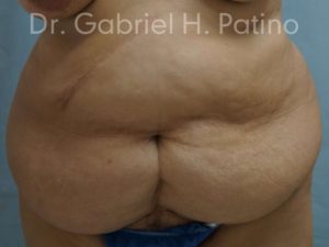  Before and After Cosmetic Surgery in Oakland, CA 