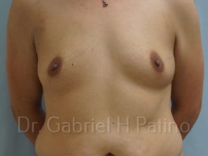  Before and After Cosmetic Surgery in Oakland, CA 