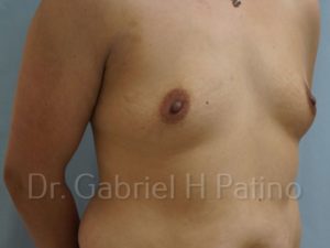  Before and After Cosmetic Surgery in Oakland, CA 