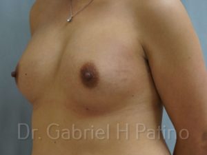  Before and After Cosmetic Surgery in Oakland, CA 