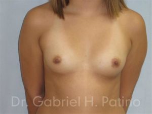  Before and After Cosmetic Surgery in Oakland, CA 