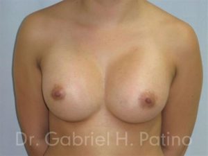  Before and After Cosmetic Surgery in Oakland, CA 