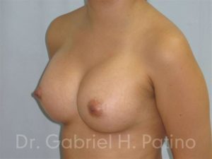  Before and After Cosmetic Surgery in Oakland, CA 