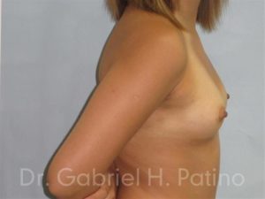  Before and After Cosmetic Surgery in Oakland, CA 