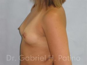  Before and After Cosmetic Surgery in Oakland, CA 