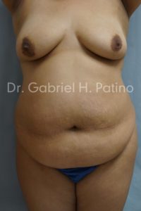  Before and After Cosmetic Surgery in Oakland, CA 