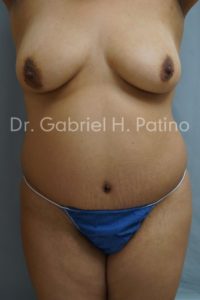  Before and After Cosmetic Surgery in Oakland, CA 