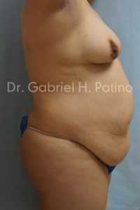  Before and After Cosmetic Surgery in Oakland, CA 