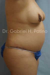  Before and After Cosmetic Surgery in Oakland, CA 