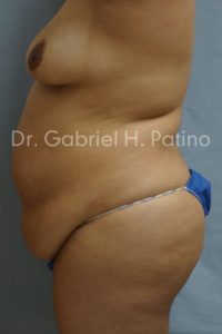  Before and After Cosmetic Surgery in Oakland, CA 