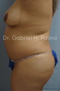  Before and After Cosmetic Surgery in Oakland, CA 