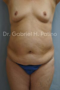  Before and After Cosmetic Surgery in Oakland, CA 