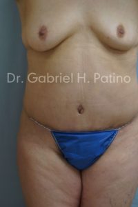  Before and After Cosmetic Surgery in Oakland, CA 