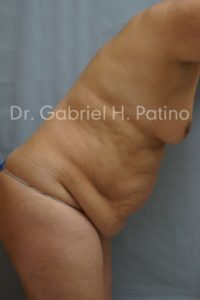  Before and After Cosmetic Surgery in Oakland, CA 