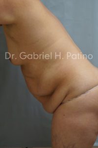  Before and After Cosmetic Surgery in Oakland, CA 