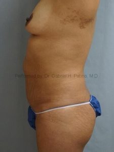  Before and After Cosmetic Surgery in Oakland, CA 