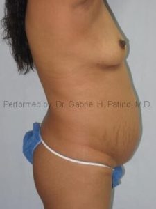  Before and After Cosmetic Surgery in Oakland, CA 