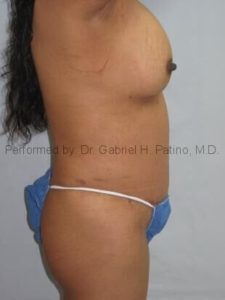  Before and After Cosmetic Surgery in Oakland, CA 