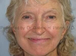  Before and After Cosmetic Surgery in Oakland, CA 