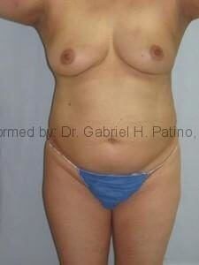  Before and After Cosmetic Surgery in Oakland, CA 